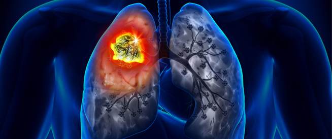 ciemnoniebieski zarys płuc człowieka ze zmianami rakowymi w kolorze czerwono-żółtym
